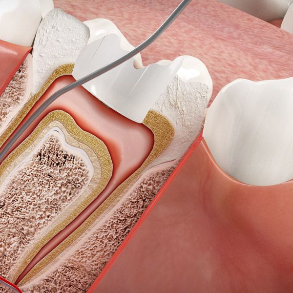Wurzelkanalbehandlung (Endodontie)